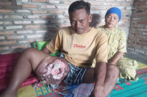 Warga Asahan Menderita Penyakit Tumor Selama 2 Tahun, Berharap Dapat Bantuan Dari Pemerintah Dan Masyarakat